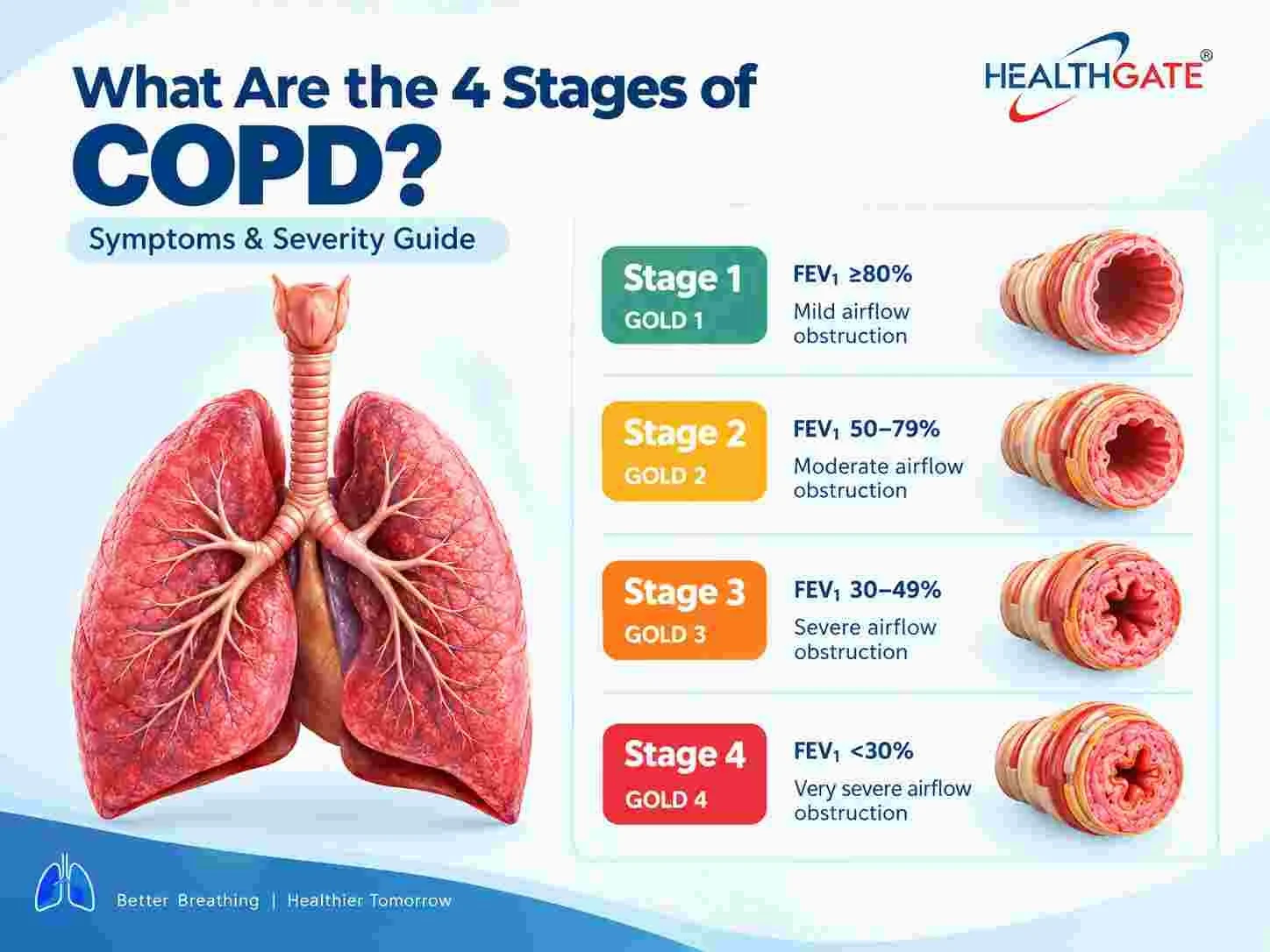 What Are the 4 Stages of COPD